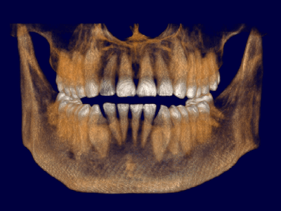 Insights Diagnostic CBCT Scan Services 11 x 8 cm (Maxilla + Mandible)